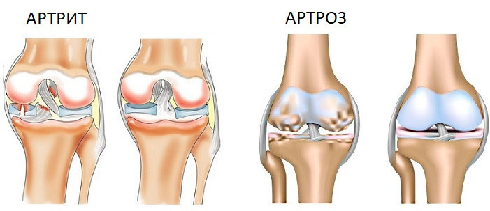 Остеоартрит и артрит вызывают боль в ногах